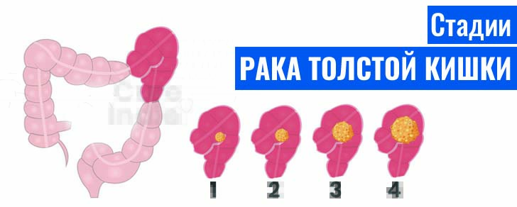 Стадии рака толстой кишки